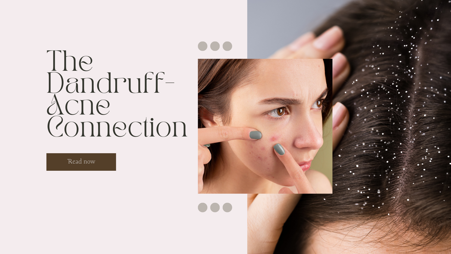 scalp hygine, dandruff, dandruff causingbacne acne , pimples , inflammation, scalp , skin and har, hair care, skin health , hygine, lifestyle