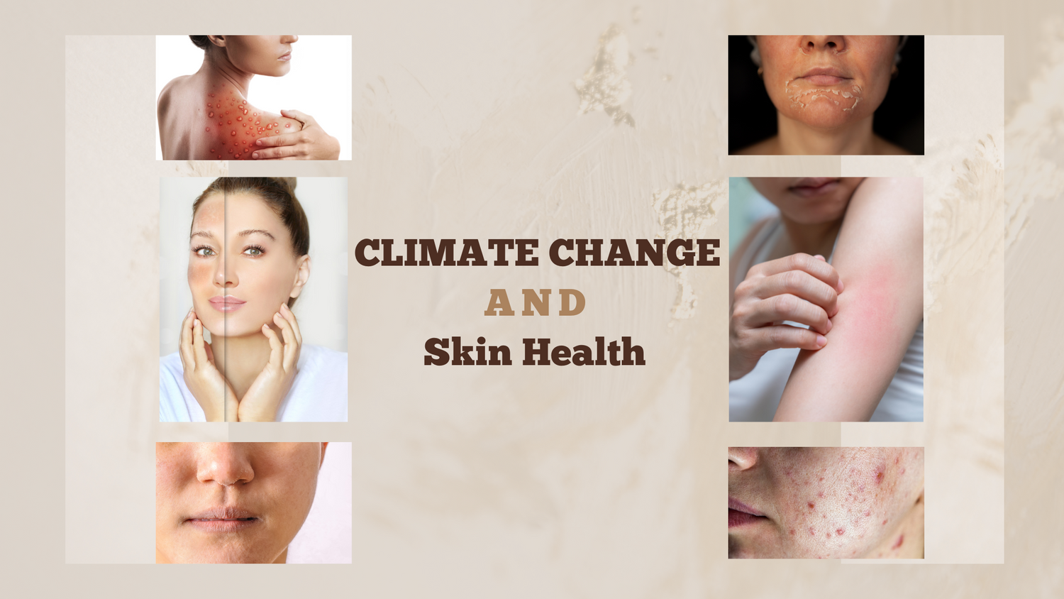 climate change , skin dryness, oily skin , acne . pimples, rashes, inflammation, redness, ski health