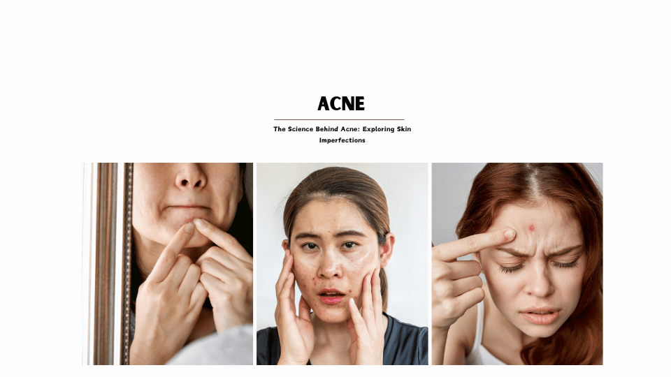 acne,pimples, how to reduce acne, forms of acne, scars, neurocosmetics, stress, hormonal acne, fungal acne, cyctic acne, pimple marks, imflammation,genetics, painfull pimples, open pores 