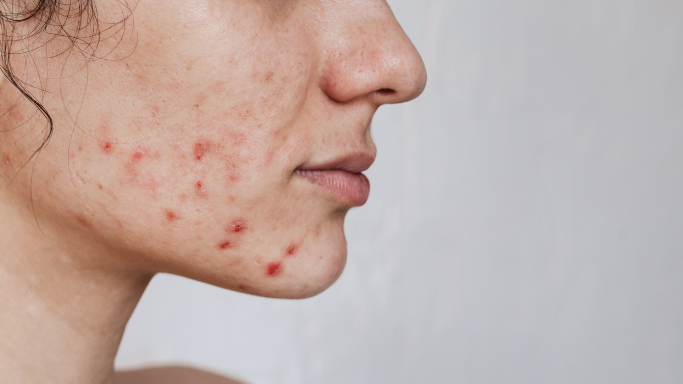 acne , adult acne , puberty , is adult acne common , hormonal acne , painfull pimples , pimples, acne reduction , tips to reduce acne , neurocosmetics, stress acne , diest acne , genetic acne , managing acne , adult acne controll