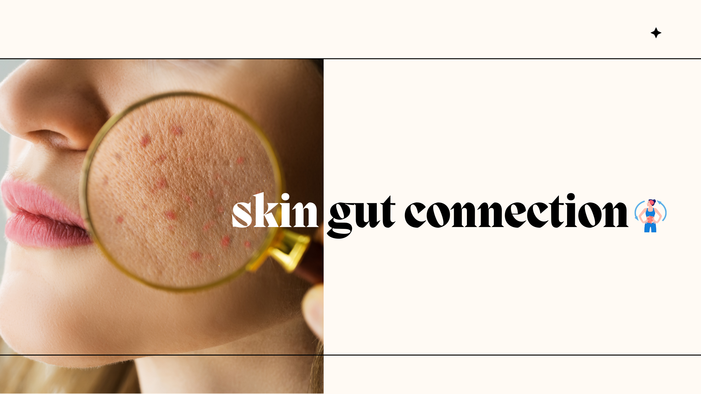 SKIN HEALTH, GUT HEALTH, ACNE , pimples ,skin - gut health  