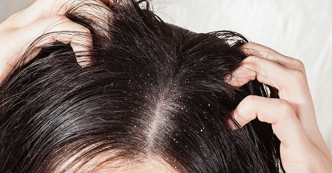 How to fight dandruff?