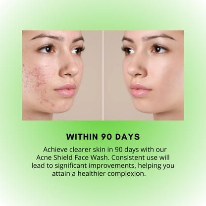 Acne Shield Face Wash – &quot;Tough on Acne, Gentle on Skin&quot;